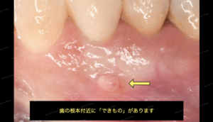 歯茎の白い出来物の腫れの治し方　外科治療・歯根端切除　１２